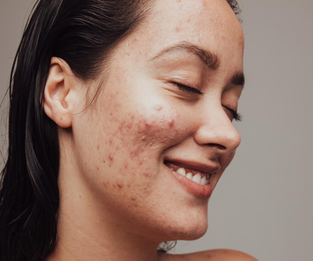 girl with hormonal acne