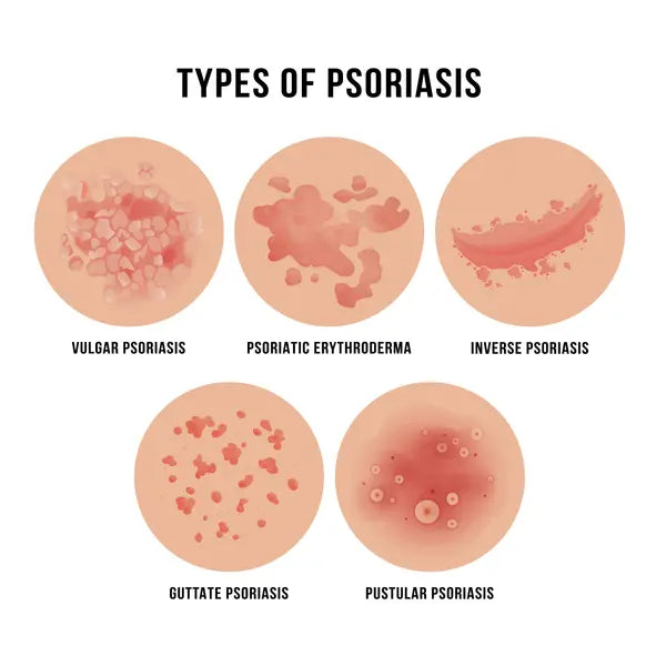 types of psoriasis
