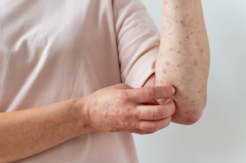 person with psoriasis